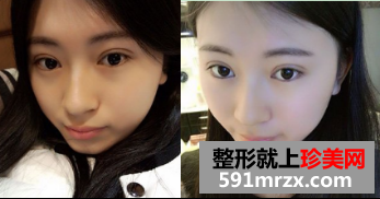 上海华美韩式三点双眼皮恢复图