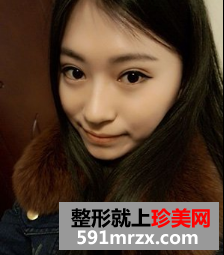 上海华美韩式三点双眼皮恢复图