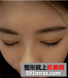 上海华美韩式三点双眼皮恢复图