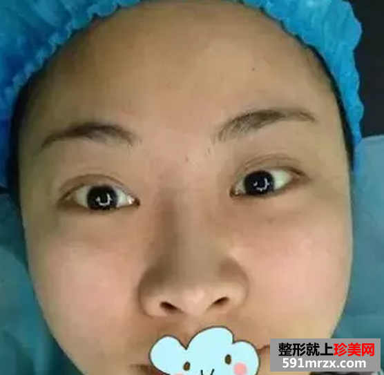 双眼皮加假体隆鼻真实案例恢复图