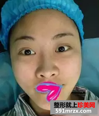双眼皮加假体隆鼻真实案例恢复图