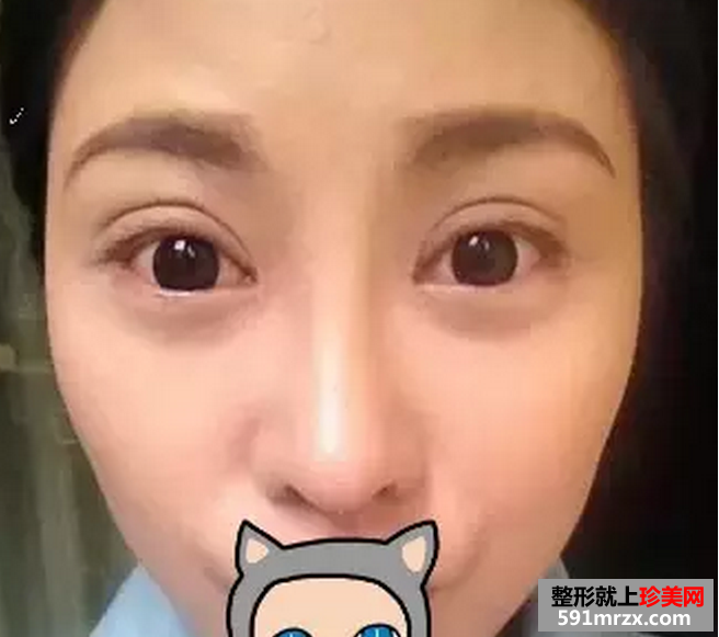 双眼皮加假体隆鼻真实案例恢复图