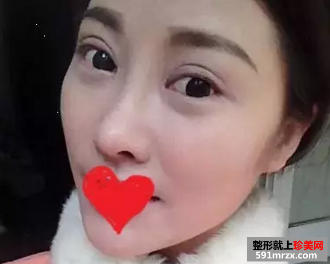 双眼皮加假体隆鼻真实案例恢复图
