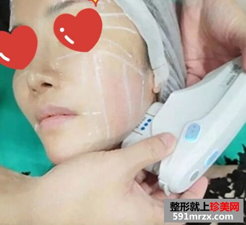 皮肤松弛下垂做了音波拉皮 效果很惊艳