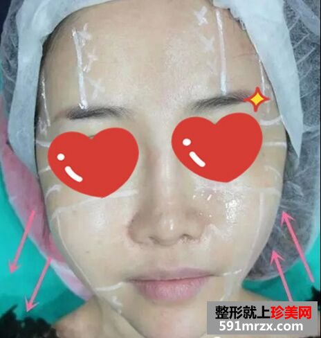 皮肤松弛下垂做了音波拉皮 效果很惊艳