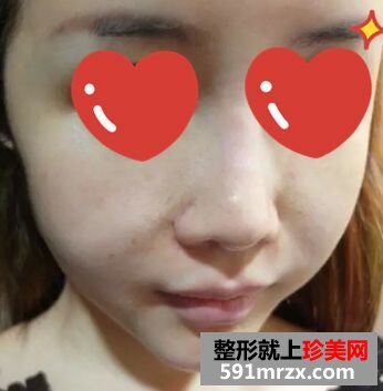 皮肤松弛下垂做了音波拉皮 效果很惊艳