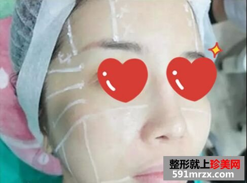 皮肤松弛下垂做了音波拉皮 效果很惊艳