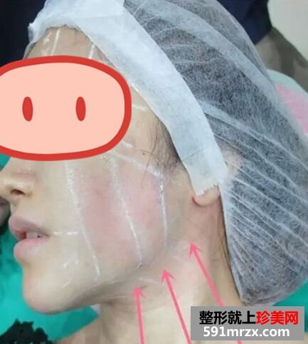 皮肤松弛下垂做了音波拉皮 效果很惊艳