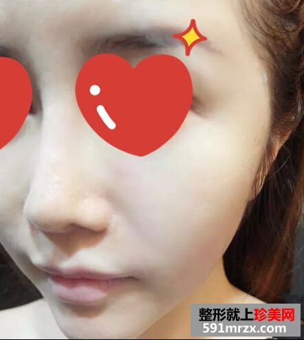 皮肤松弛下垂做了音波拉皮 效果很惊艳