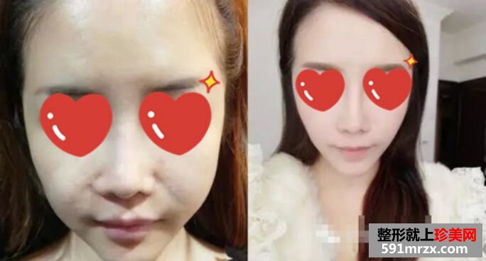 皮肤松弛下垂做了音波拉皮 效果很惊艳