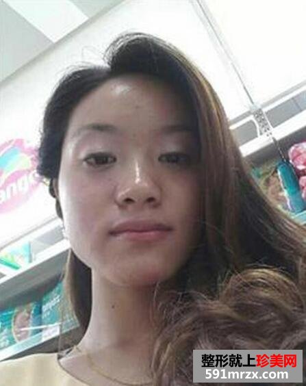 假体隆鼻真实案例效果对比图