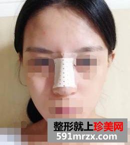硅胶隆鼻+耳软骨垫鼻尖效果图分享