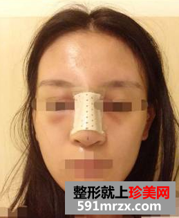 硅胶隆鼻+耳软骨垫鼻尖效果图分享