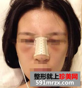 硅胶隆鼻+耳软骨垫鼻尖效果图分享