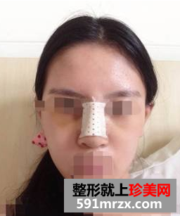 硅胶隆鼻+耳软骨垫鼻尖效果图分享