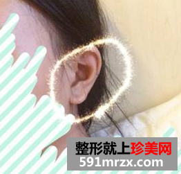 硅胶隆鼻+耳软骨垫鼻尖效果图分享