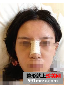 硅胶隆鼻+耳软骨垫鼻尖效果图分享