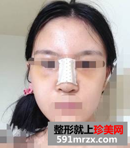硅胶隆鼻+耳软骨垫鼻尖效果图分享