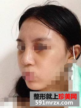 硅胶隆鼻+耳软骨垫鼻尖效果图分享