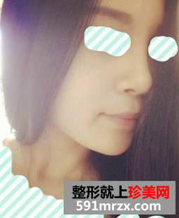 硅胶隆鼻+耳软骨垫鼻尖效果图分享