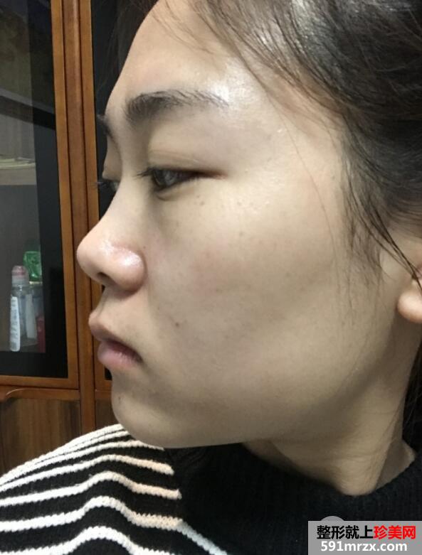 上海百达丽鼻综合真实效果恢复对比图案例分享 改变我的塌鼻子