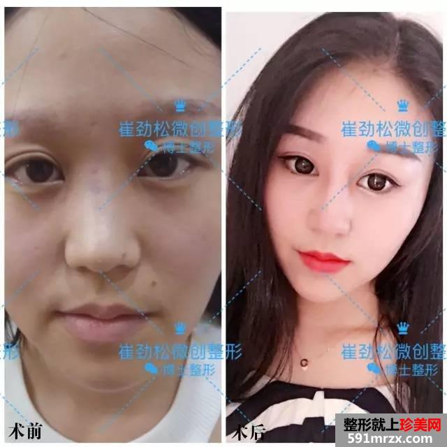 自体耳软骨 假体综合隆鼻一个月对比效果照片分享
