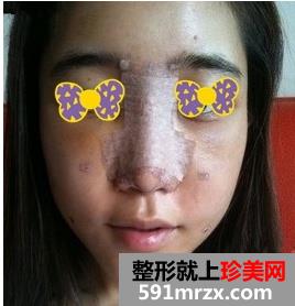 西安画美医疗美容医院假体综合隆鼻前后对比效果图