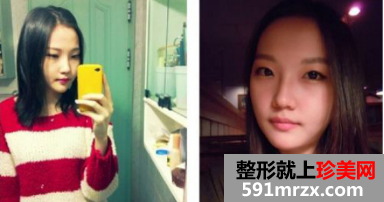 上海九院下颌角整形效果怎么样 上海九院下颌角案例！