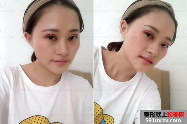 韩式全切双眼皮 开眼角半个月前后对比效果照片分享