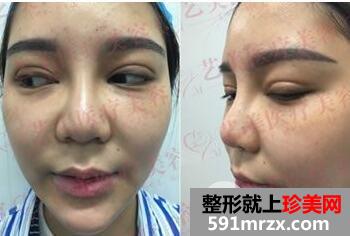 广州艺美李闯鼻综合修复手术真实案例，前后对比图分享