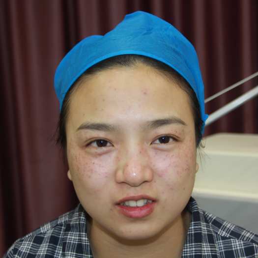 做了皮秒激光祛斑和美白嫩肤,脸上没有雀斑了