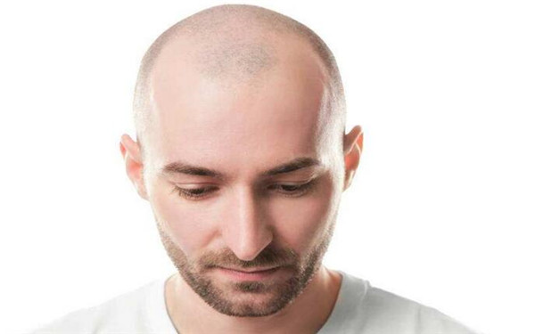 秃顶植发有副作用吗