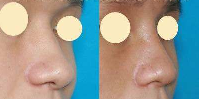 鼻头缩小手术有风险吗，术后如何护理