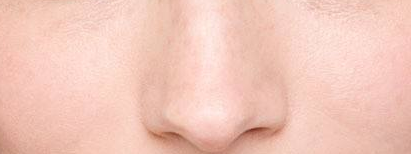 鼻翼缩小手术有什么后遗症