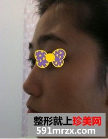 上海万众整形医院假体综合隆鼻前后对比效果图片