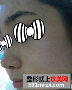 上海万众整形医院假体综合隆鼻前后对比效果图片