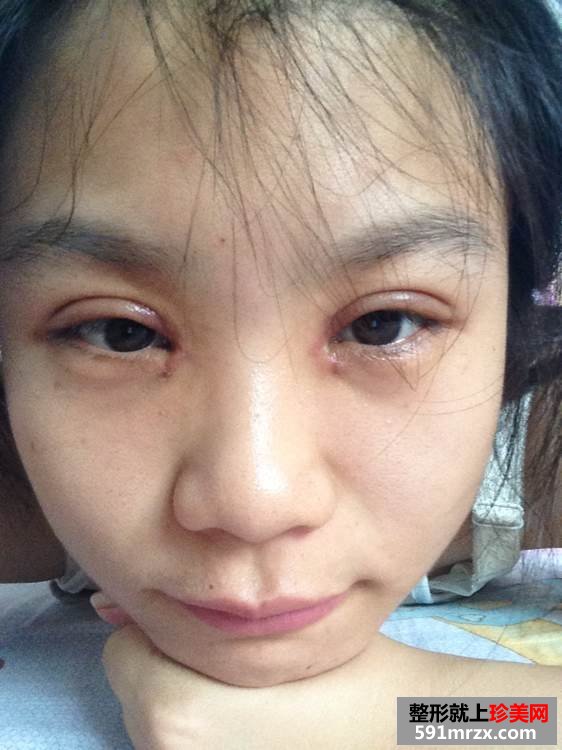 北京全切双眼皮 开眼角前后对比效果图片
