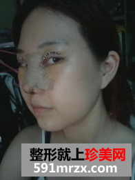 隆鼻割双眼皮多久恢复 北京东方瑞丽割双眼皮+硅胶隆鼻归来